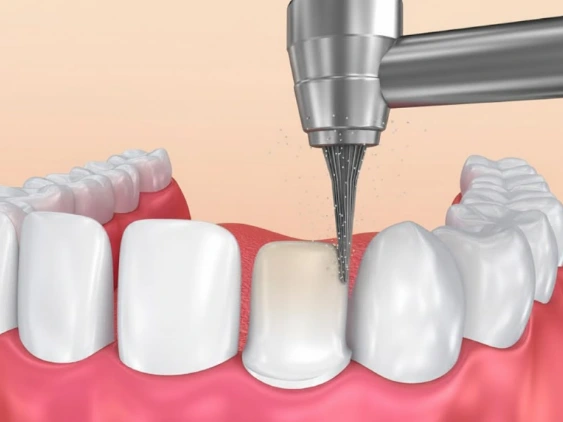  Bọc sứ cho răng thưa sẽ mài một lớp men răng mỏng